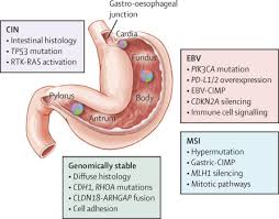 In countries where screening for stomach cancer is not routine, such as the united states, most stomach cancers aren't found until they've grown fairly large or have spread outside the stomach. Gastric Cancer The Lancet