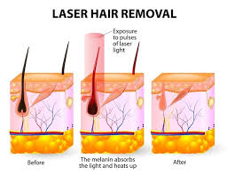 It had been performed experimentally for about twenty years before becoming commercially available in 1995 and 1996. How Much Would A Laser Hair Removal Treatment Cost In India Is It Safe What Are The Best Clinics For It Quora