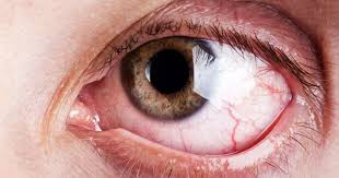 Image result for Dry Eye