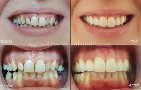 Verschiedene möglichkeiten, die weisheitszähne zu ziehen. Smile Design Zahnkronen