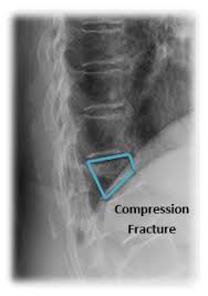 Image result for Vertebral Compression Fracture