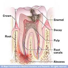 If the pain is persistent and strong, or if your teeth feel particularly weak, it is likely that your tooth's pulp is damaged and that you will need a root canal. Root Canal Treatment Alliance Dental Center Dentists In Jackson Heights Queens Ny 11372 718 424 7100
