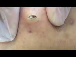 Selbst wenn die haut schon wieder heilt, knibbeln sie die krusten erneut ab. Blackheads Compilation Pimple Popping Removing Blackheads Compilation Pimple Popping Removing Pickel Ausdrucken Pickel Entfernung Mitesser Ausdrucken