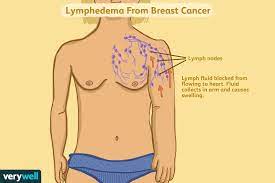 Unlike inflammatory breast cancer, however, mastitis usually causes a fever and is easily treated with antibiotics. Lymphedema In Breast Cancer Symptoms Causes Diagnosis And Treatment