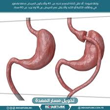 Homologous recombination (hr) and nonhomologous dna end joining (nhej). ØªØ­ÙÙÙ ÙØ³Ø§Ø± Ø§ÙÙØ¹Ø¯Ø© ÙÙ ØªØ±ÙÙØ§ Ø´Ø¨ÙØ© Ø±ÙÙØ§Ø¨ØªÙØ±Ù ÙÙØ¹ÙØ§Ø¬ ÙÙ ØªØ±ÙÙØ§