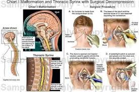 Chiari Surgery The Scariest Shit I Ve Ever Have Gone Through In My Life Chiari Malformation Chiari Chiari Malformation Surgery
