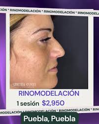 🌟 Rinomodelación estética