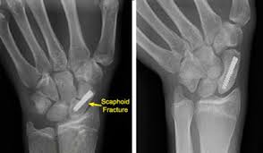 Image result for Scaphoid Fracture Signs