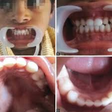 Intraoral photographs of a child without S-ECC
