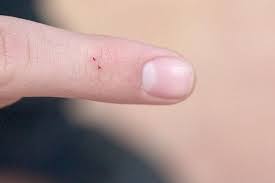Allergic Reaction Black Ant Bites Pictures Pictures Of Skin Rashes With Images Spider Bites Pictures Spider Bites Black Widow Spider Bite