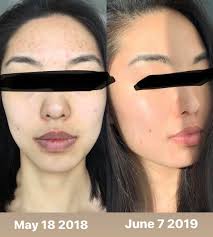My honest UPS & DOWNS with AB! Started AB with good skin 2017, broke out  2018, & back to good skin in 2019. More details in comments. : r/AsianBeauty
