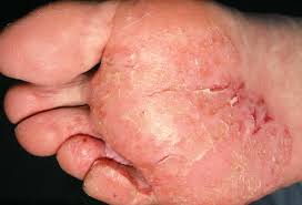 Pictures Of Skin Infections