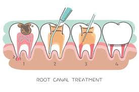 If the treatment needs to be but if an infection does return, the root canal treatment can be repeated. What Happens If You Don T Get A Root Canal When Needed