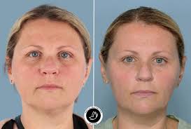 Facial Balancing ✖️ Marissa Subtle enhancements that make a BIG difference.  By using injectable filler to balance your face