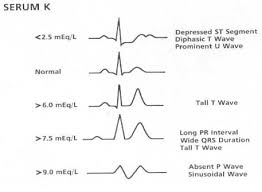 Hypopotassemia Ekg Google Search Hyperkalemia Heart Treatment Pr Interval