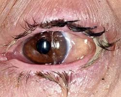 acute conjunctivitis pink eye photo nhs, AI generated