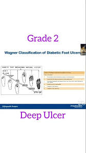 Image result for Wagner Ulcer Classification