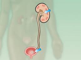 Ureteral Stent Bladder Pain Patient Education Engagement