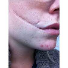 Glasgow grin worst punishment in the history of mankind. Pin By Spoopy On Truthhhh Glasgow Smile Bruises Scar