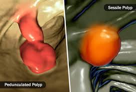 Nasal polyps are polyps in nasal cavity. Polyp Pictures What They Are And What Polyps Look Like