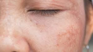 Depigmentation de la peau cause. Hyperpigmentation De La Peau Symptomes Causes Solutions