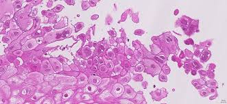 Very few cases of a multiple viral infection have been reported. Amiens Pathology Amienspathology Twitter