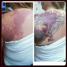 Back Birthmark Cover Up Tattoo Freehand Coverup Of Birthmark Inspirational Tattoos Birthmark I Tattoo