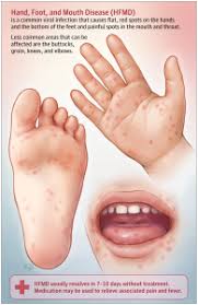 Image result for Hand foot and mouth disease HFMD roof of mouth