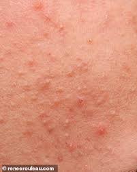 They are known as milia. Skin Expert Reveals The Different Imperfections That Can Affect The Complexion Daily Mail Online