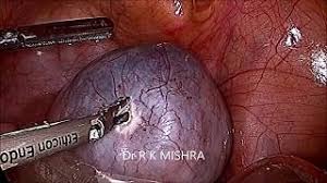 Check spelling or type a new query. Bilateral Dermoid Cyst Youtube