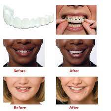 We need to say that these are photographs provided by the manufacturer, and your results. The Original Clip On Smile Instant Smile Veneer Outletizer