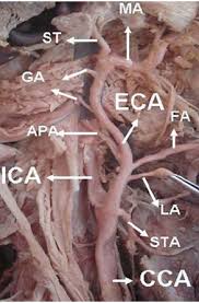 Women appear to be at higher risk of early complications associated with carotid endarterectomy (cea) and lower risk of stroke for any degree of stenosis compared with men. Photograph Of The Right Side Of The Face And Neck Shows The Course Of Download Scientific Diagram