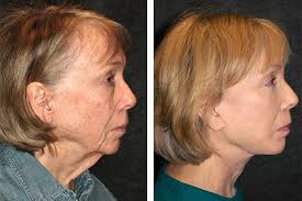 Moving on, women are encouraged to choose curly hairstyles because of the wide choice variety. Neck Lift Surgery Best New York Neck Lift Necklift Specialist