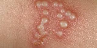How do you contract hsv 1? Herpes Simplex Virus Hsv 2 The Dermatology Specialists