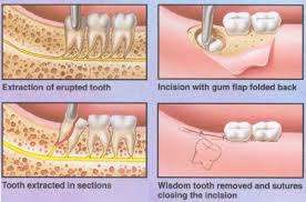 Wisdom Teeth Removal Necessary Why Need To Extract Them