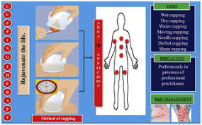 cupping therapy a prudent remedy for a plethora of medical