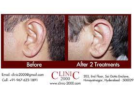 Ear Hair Permanent Removal Modern Men Are Equally Diligent Of Uncontrolled Hair Growth On Th Laser Hair Removal Cost Permanent Laser Hair Removal Laser Clinic