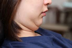 Obat bengkak di bawah dagu. 4 Cara Menghilangkan Double Chin Secara Alami Dan Dengan Bantuan Obat Halaman All Kompas Com