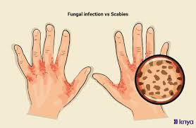 Image result for scabies transmission