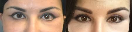 The lower lid has more emphasis and looks longer than the top lid, explains jeffrey. Everything You Need To Know About Eye Shape Surgery Los Angeles