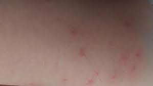 Petit points rouges sur la peau. Demangeaisons Boutons Rouges Qu Est Ce Que La Puce De Canard Ce Mal De L Ete