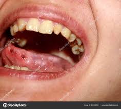 Image result for Puchýře na jazyku