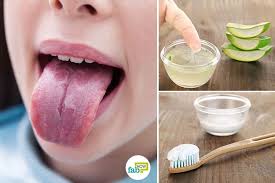 7 Most Effective Remedies To Get Rid Of Burning Mouth Syndrome Burning Mouth Syndrome Burning Tongue Syndrome Burnt Tongue Remedies