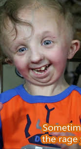 Jesse is diagnosed with Pitt-Hopkins syndrome, a condition that alters his  18th chromosome. Although he is nonverbal, Jesse still communicates in many  ways.