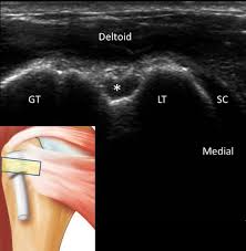 Image result for Biceps Tendon Injection