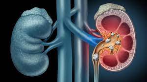 Acute renal failure occurs when renal function suddenly declines to very low levels, so that little or no urine is formed, and the substances, including even water, that the kidney normally eliminates are. Dapagliflozin Earns Breakthrough Therapy Designation For Chronic Kidney Disease
