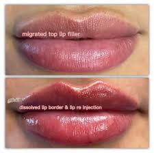 Filler Dissolving - Dentalkind