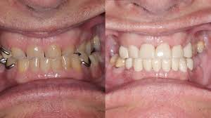 Click on each image to see a enlarged version in more detail. Dean Crowns And Partial Dentures Walton Dentistry