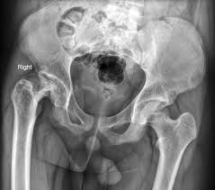 Simply put, wounds cannot heal when necrotic tissue is present. Avascular Necrosis Of The Hip Joint Radiology Case Radiopaedia Org