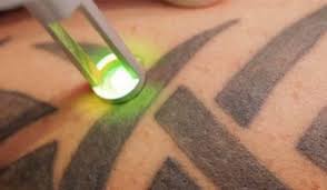 These are much more natural remedies, but focus on gradually lightening of the whole area of skin and take a long time to show results. How To Remove A Permanent Tattoo The Good Look Book